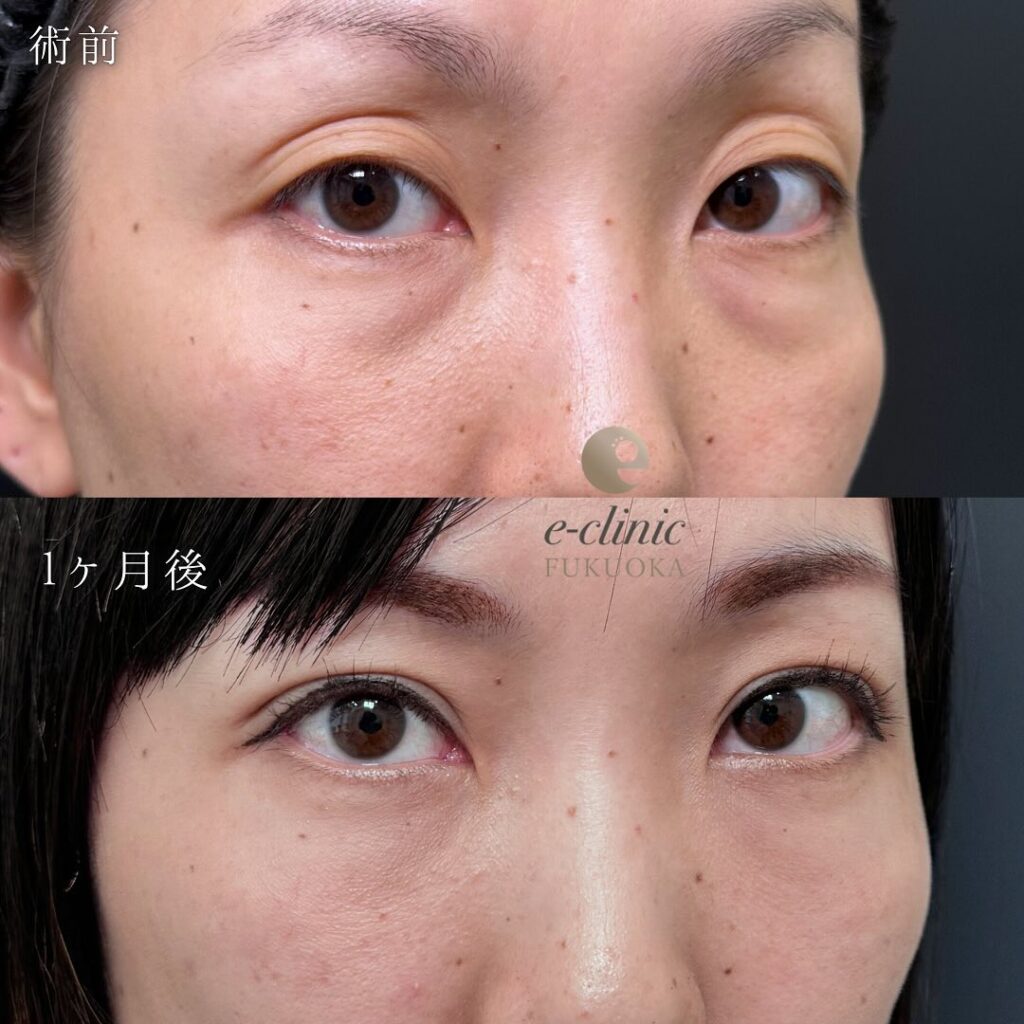 自然癒着法と裏ハムラ法の症例写真 (2)