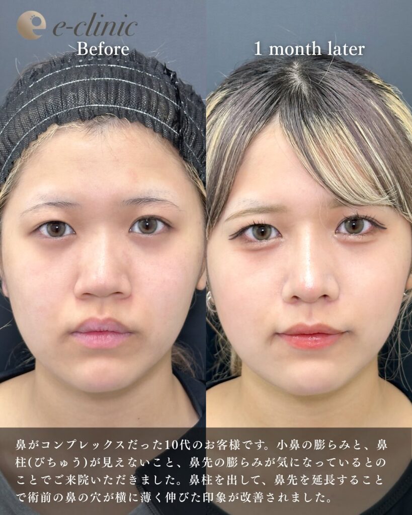 鼻中隔延長と鼻尖形成と軟骨移植と小鼻縮小と鼻柱下降とプロテーゼの症例写真 (10)