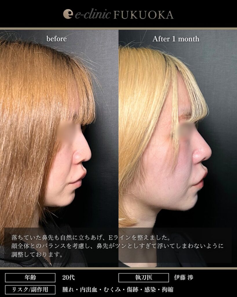 鼻尖形成と軟骨移植と小鼻縮小の症例写真 (25)