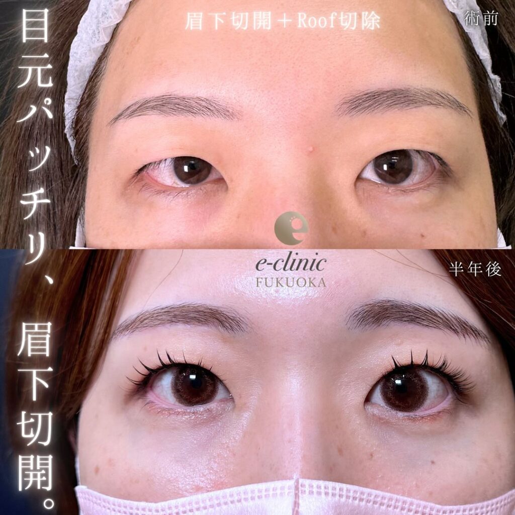 眉下切開の症例写真 (4)