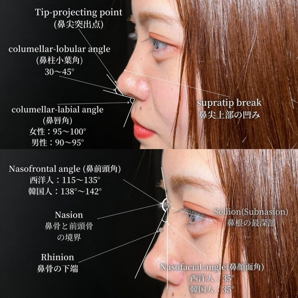 鼻中隔延長と鼻尖形成と軟骨移植とプロテーゼと他院修正の症例写真 (1)