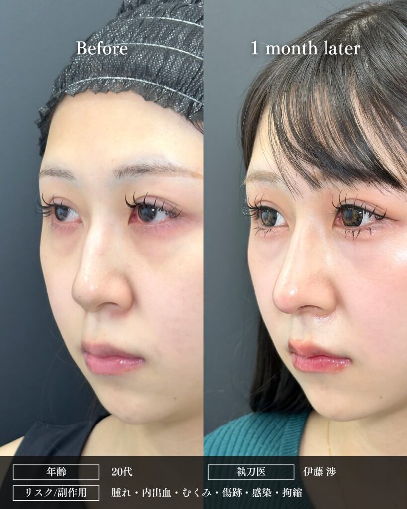 鼻中隔延長と鼻尖形成と軟骨移植と鷲鼻修正の症例写真 (4)