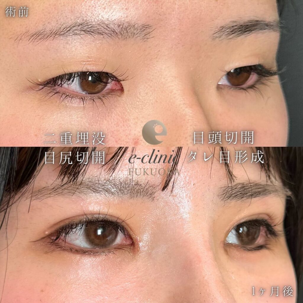 目の全方向拡大術の症例写真 (4)