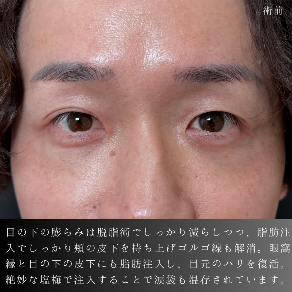 脱脂と脂肪注入の症例写真 (9)