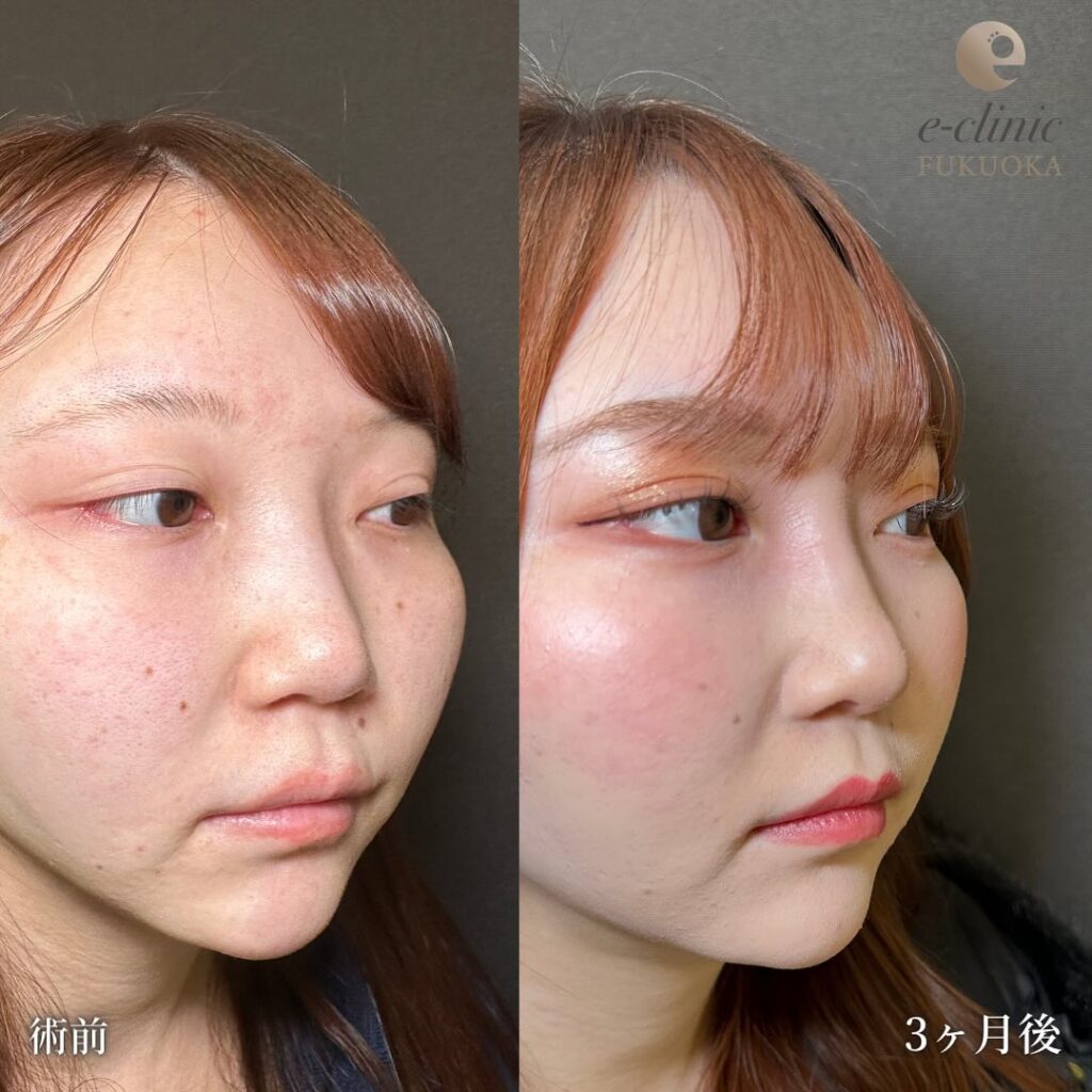 鼻尖形成と軟骨移植と耳介軟骨移植と鼻柱下降の症例写真 (2)