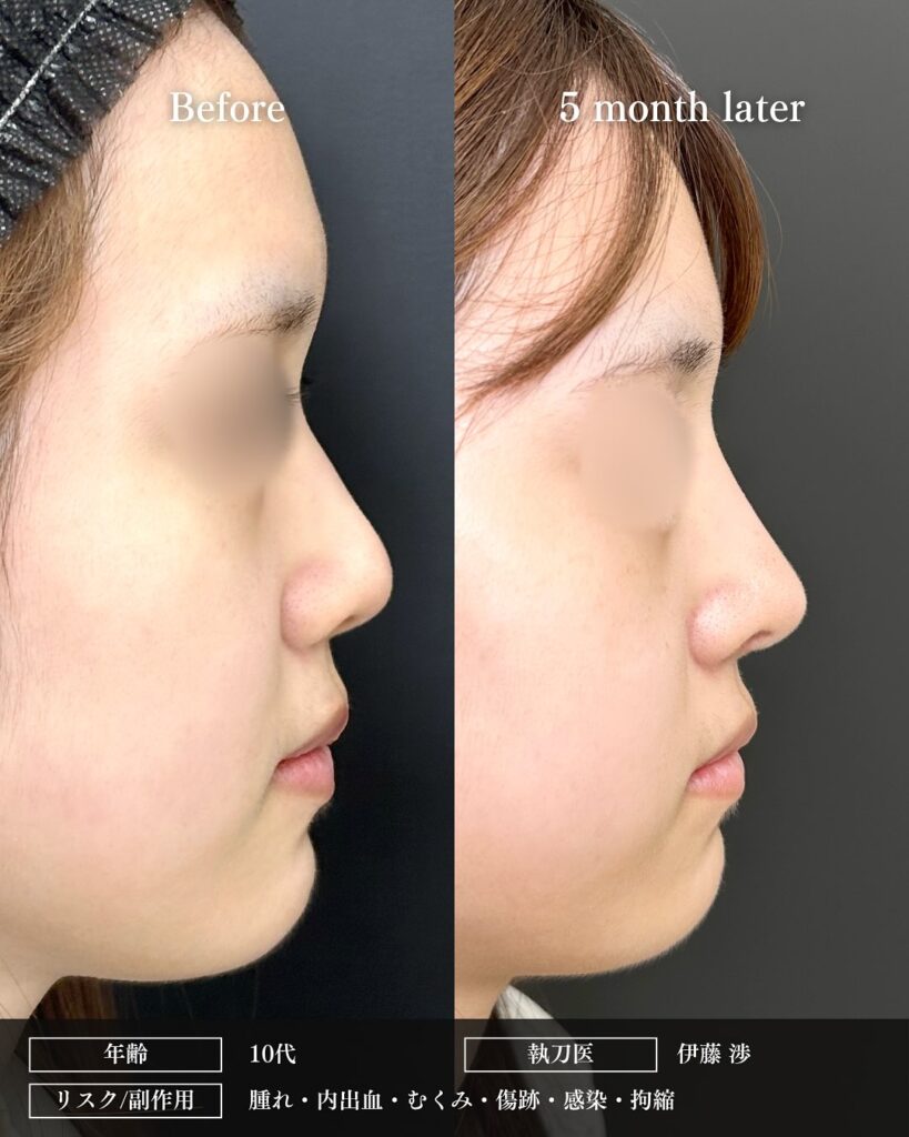 鼻中隔延長と鼻尖形成と耳介軟骨とプロテーゼと小鼻縮小と小鼻ボトックスの症例写真 (2)