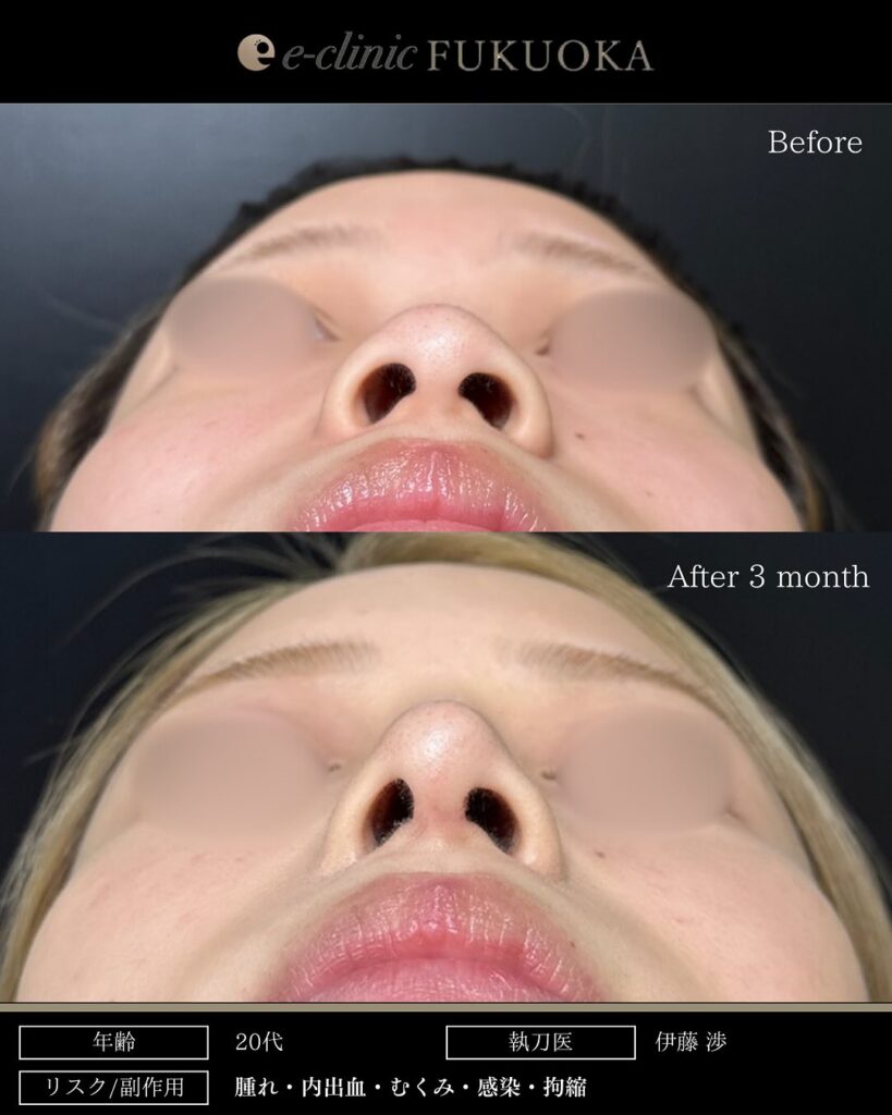 鼻尖形成と軟骨移植と小鼻縮小とプロテーゼの症例写真 (8)