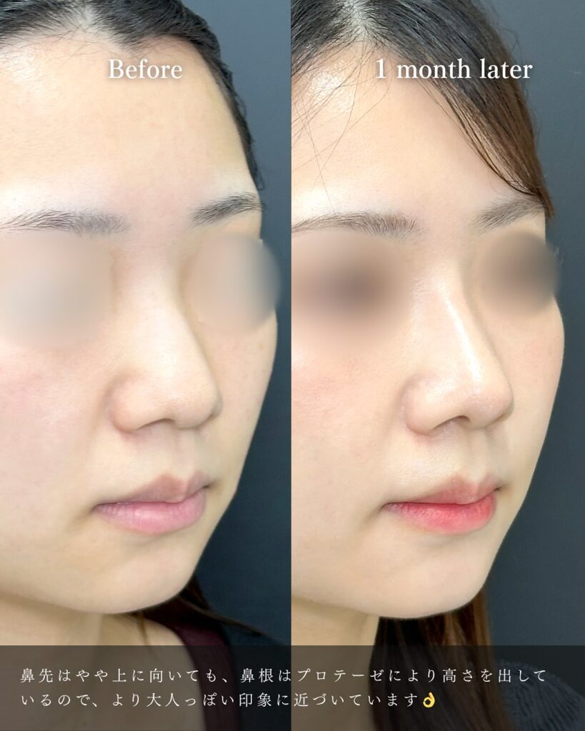 鼻尖形成と軟骨移植とプロテーゼの症例写真 (22)