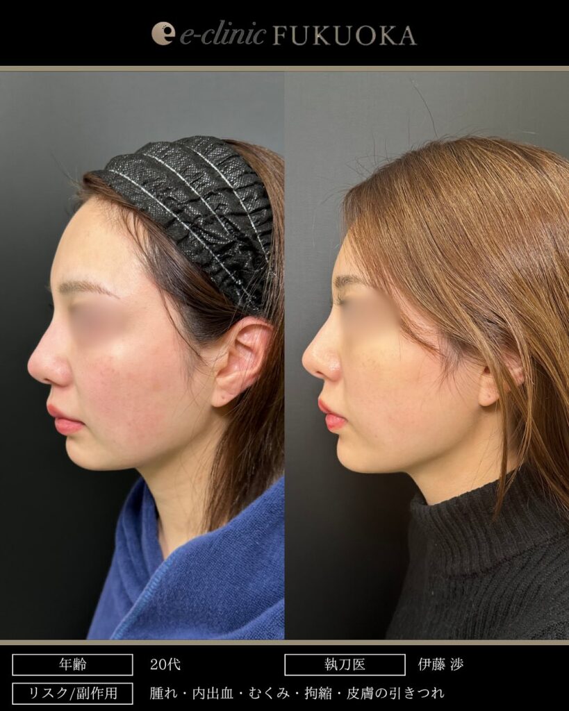 頬と顎下の脂肪吸引とジョールファットとバッカルファットと糸リフトの症例写真 (3)