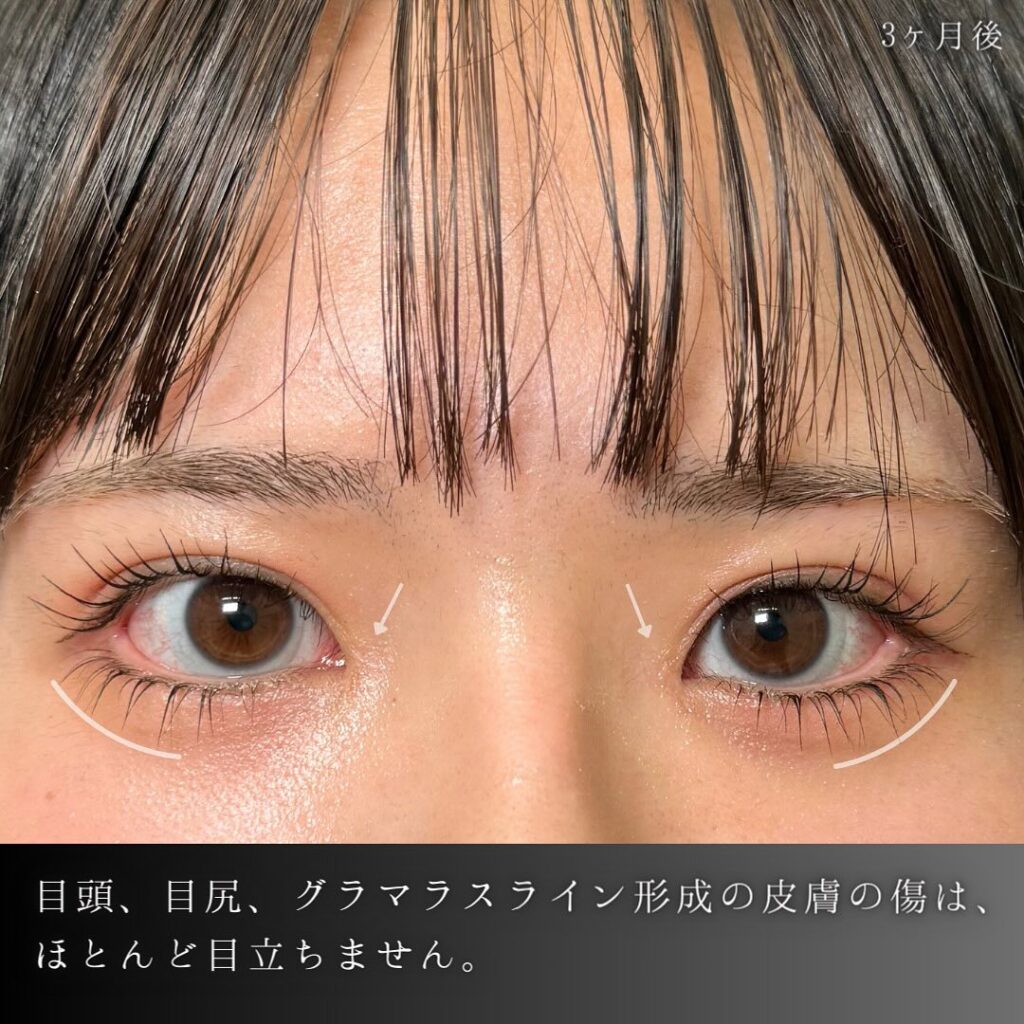 埋没法と目頭切開と目尻切開とタレ目形成の症例写真 (3)