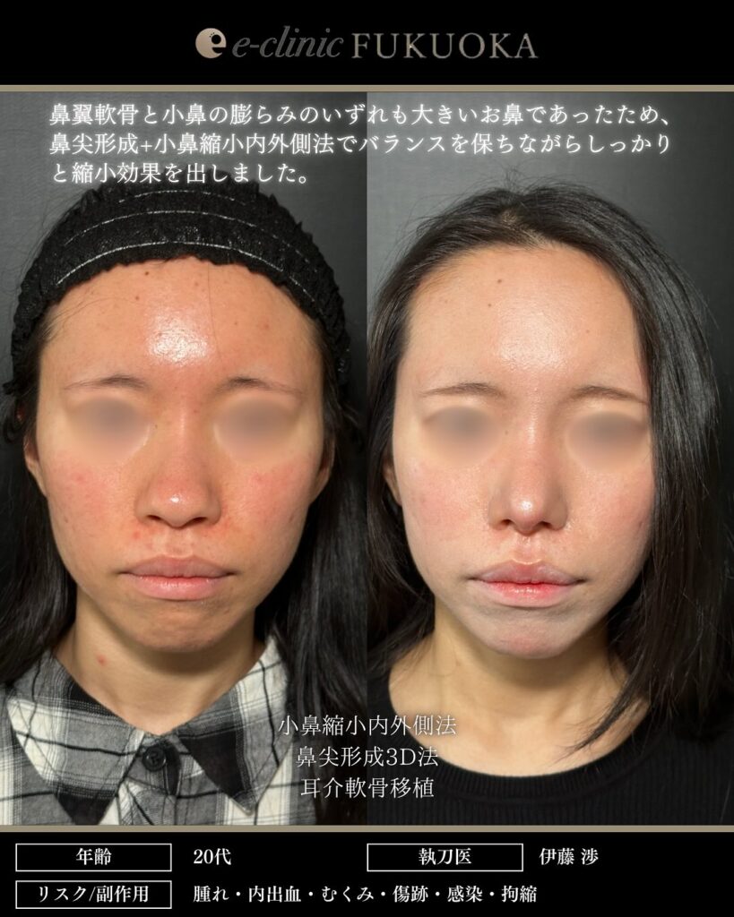 鼻尖形成と軟骨移植と小鼻縮小の症例写真 (22)