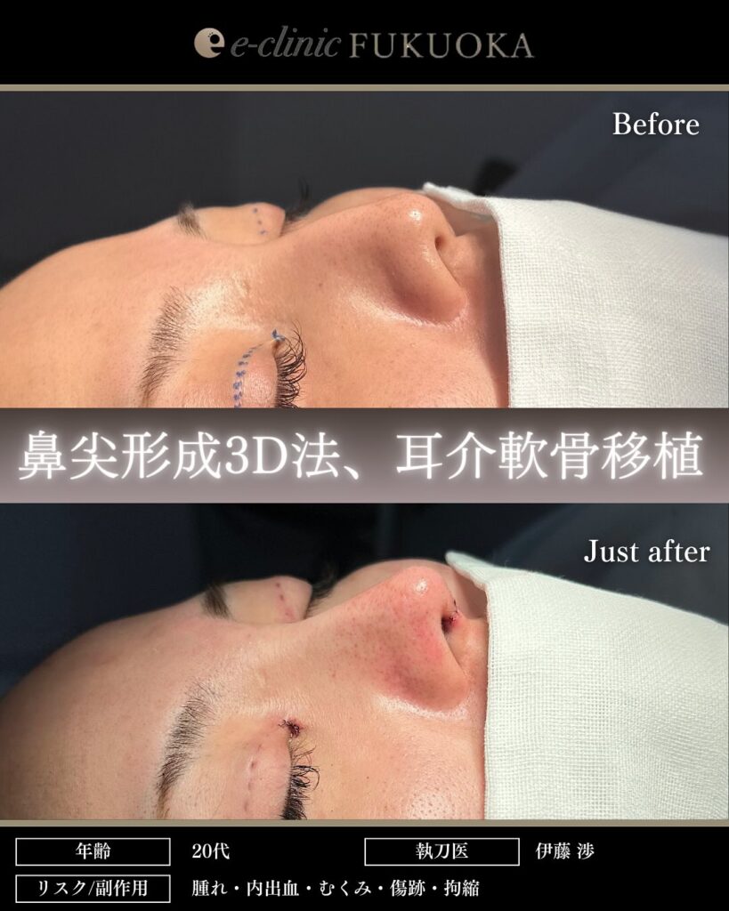 鼻尖形成と軟骨移植の症例写真 (22)