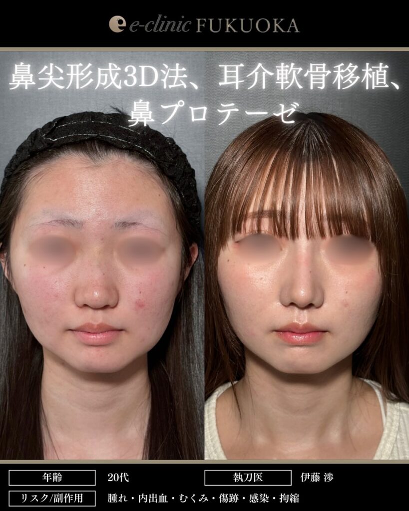 鼻尖形成と耳介軟骨移植と鼻のプロテーゼの症例写真 (1)