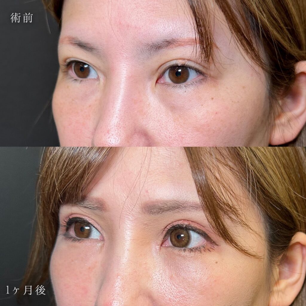 目の全方向拡大とクマ取りの症例写真 (4)