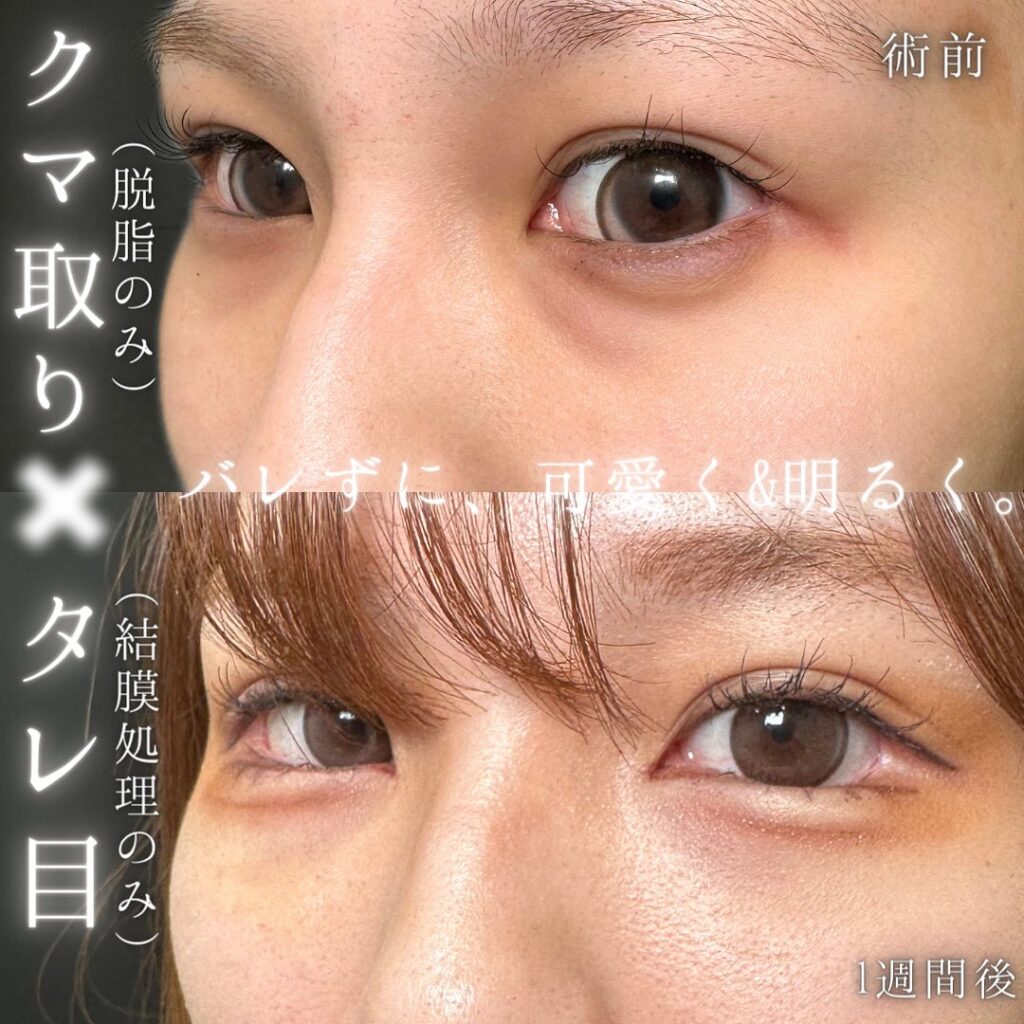 脱脂とタレ目形成の症例写真 (1)