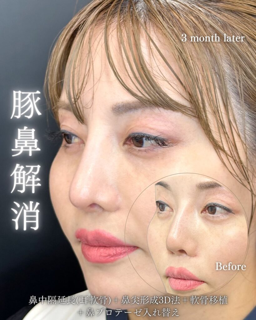 鼻尖形成と軟骨移植とプロテーゼ入れ替えの症例写真 (1)