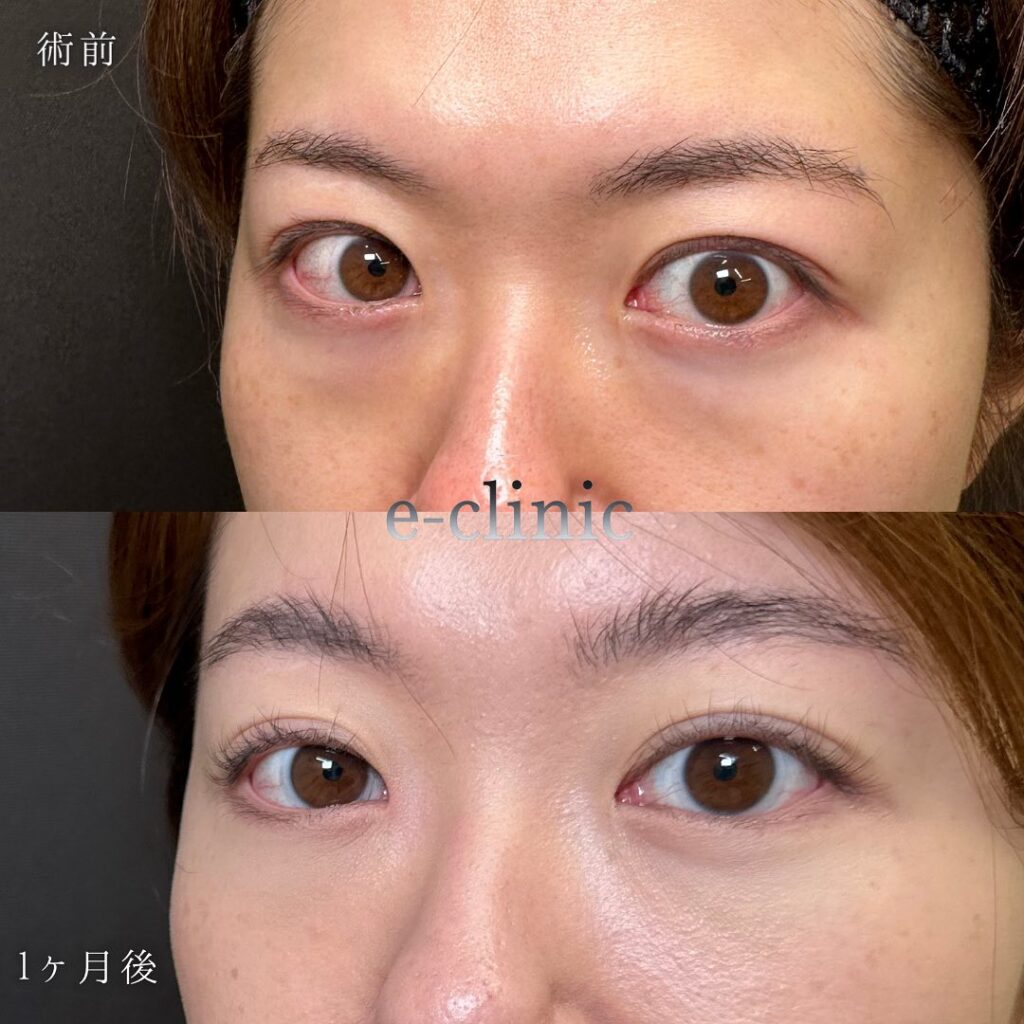 裏ハムラ法の症例写真 (26)