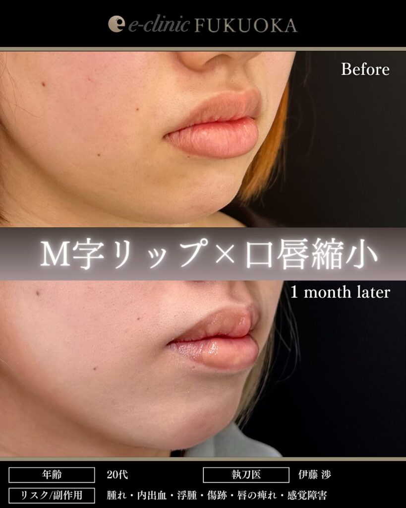 M字リップ+唇縮小の症例写真 (3)