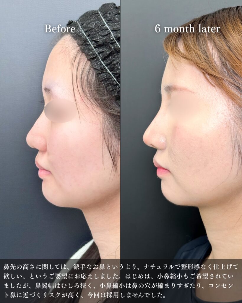 鼻尖形成と耳介軟骨移植とプロテーゼの症例写真 (8)