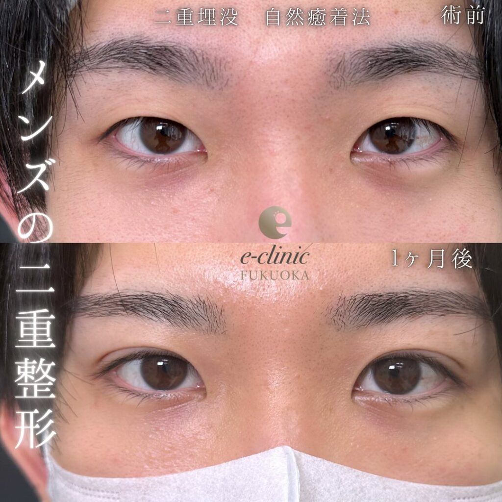 自然癒着法の症例写真 (11)