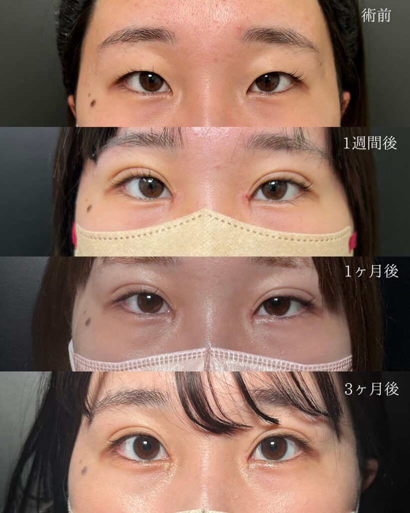 埋没法と目頭切開の症例写真 (5)