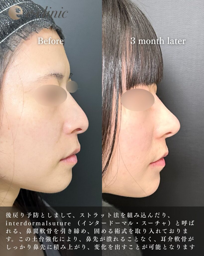 鼻尖形成+軟骨移植の症例写真 (4)