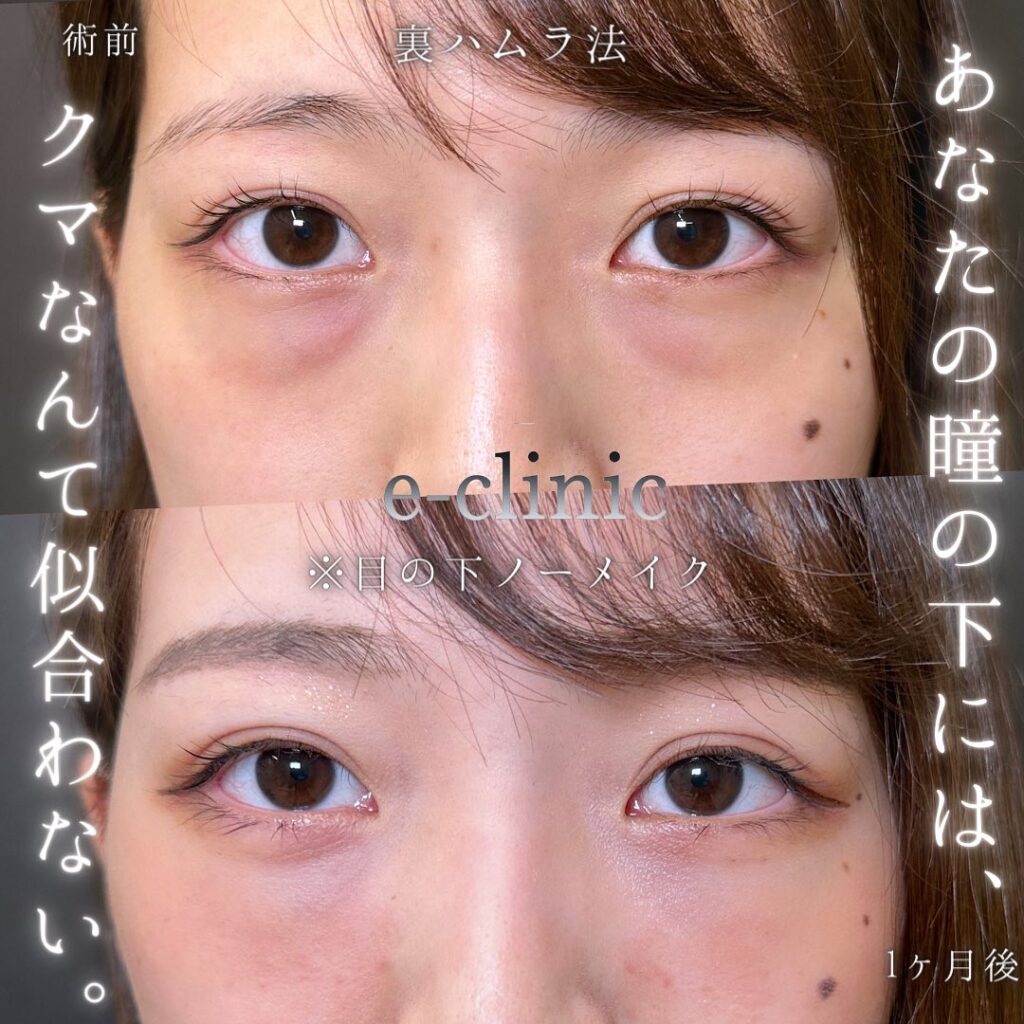 裏ハムラ法の症例写真 (50)