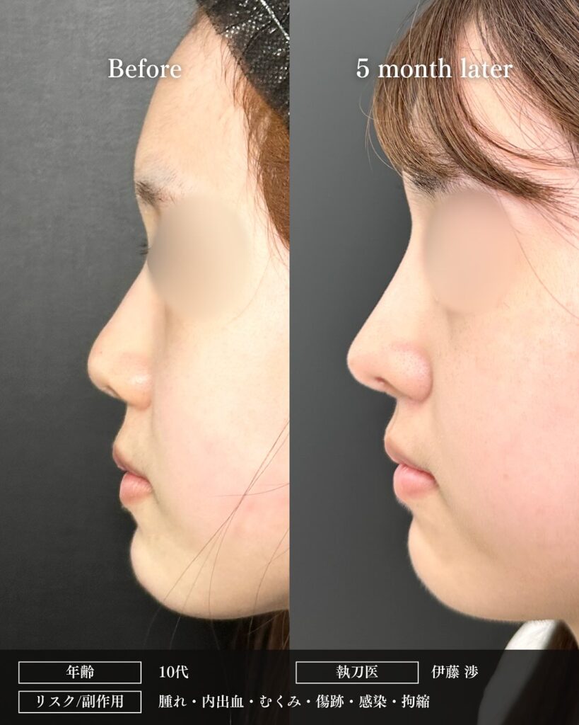 鼻中隔延長と鼻尖形成と耳介軟骨とプロテーゼと小鼻縮小と小鼻ボトックスの症例写真 (3)