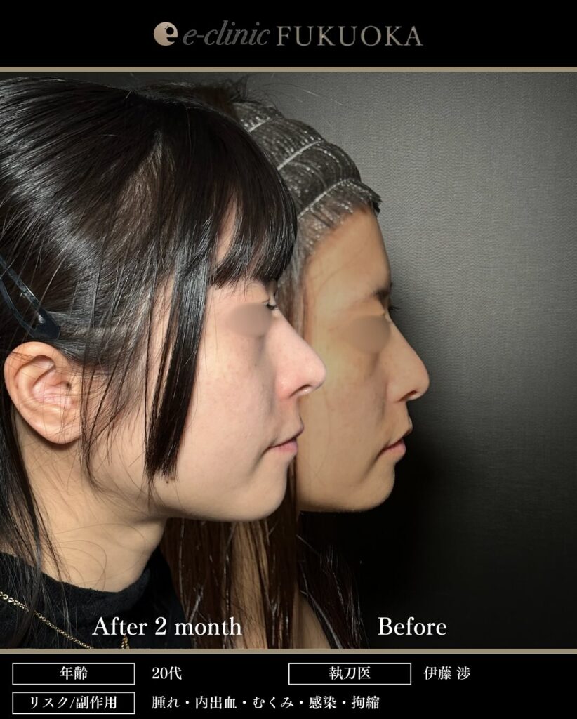 鼻尖形成と軟骨移植の症例写真 (26)