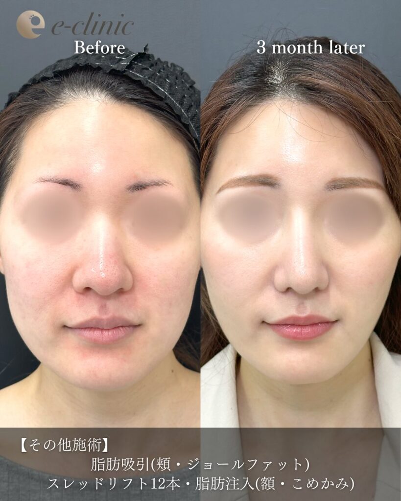 鼻尖形成と軟骨移植とプロテーゼと小鼻縮小と脂肪注入と頬の脂肪吸引とジョールファットと糸リフトの症例写真 (6)