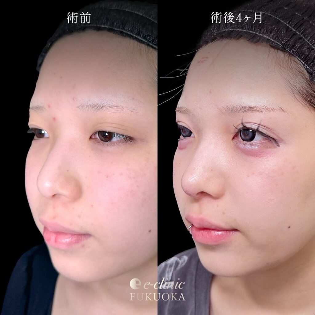 鼻尖形成と軟骨意欲と小鼻縮小の症例写真 (5)