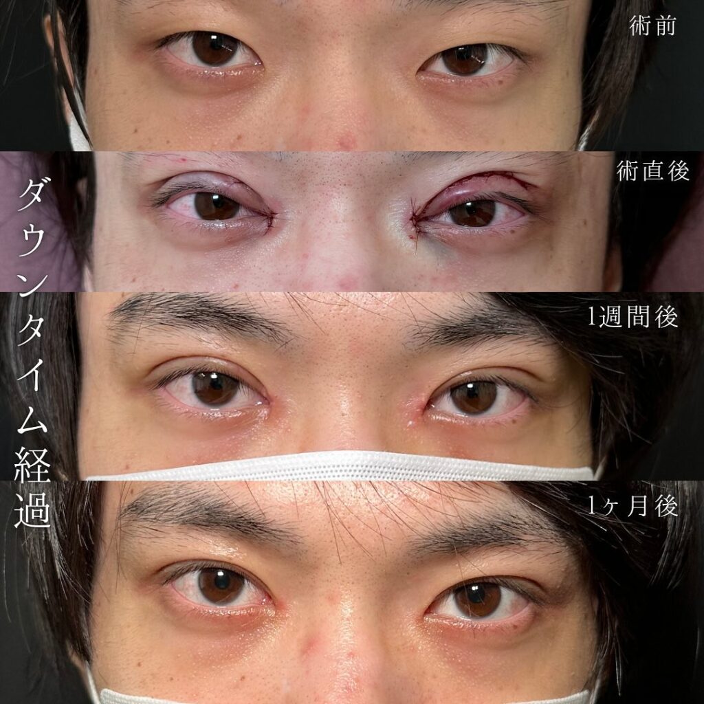 たるみ取り併用全切開と目頭切開の症例写真 (3)