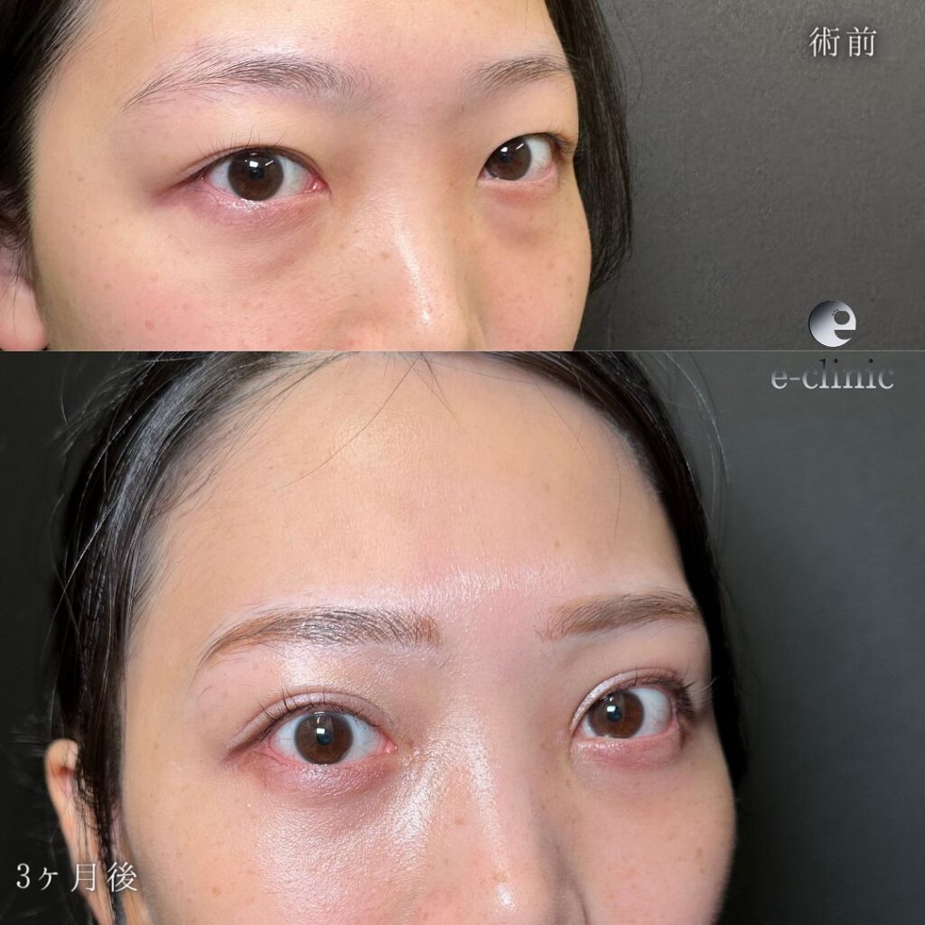 目の全方向拡大と脱脂の症例写真 (2)