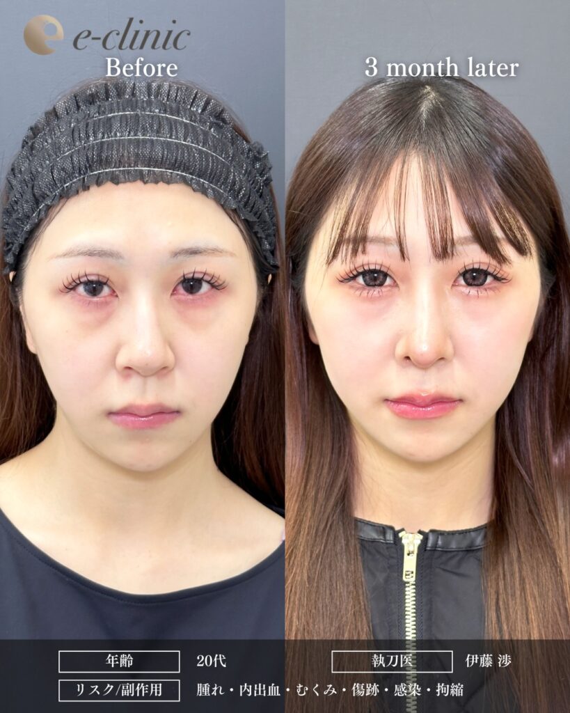 鼻中隔延長と鼻尖形成と軟骨移植と鷲鼻修正の症例写真 (7)