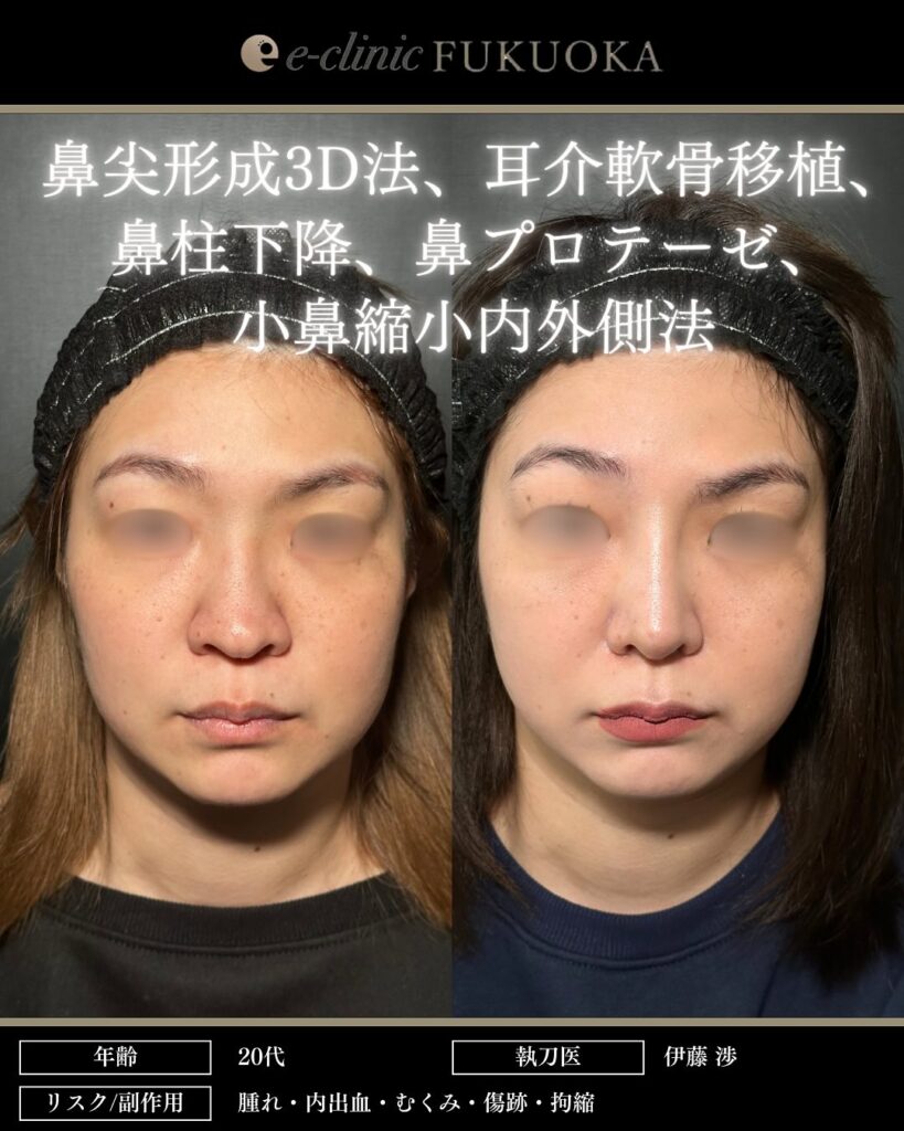 鼻尖形成と耳介軟骨移植と鼻柱下降とプロテーゼと小鼻縮小の症例写真 (1)