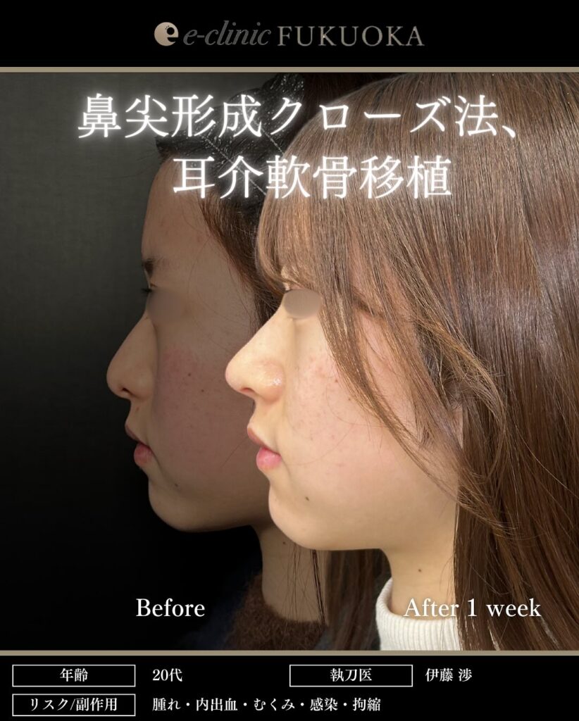 鼻尖形成と軟骨移植の症例写真 (17)