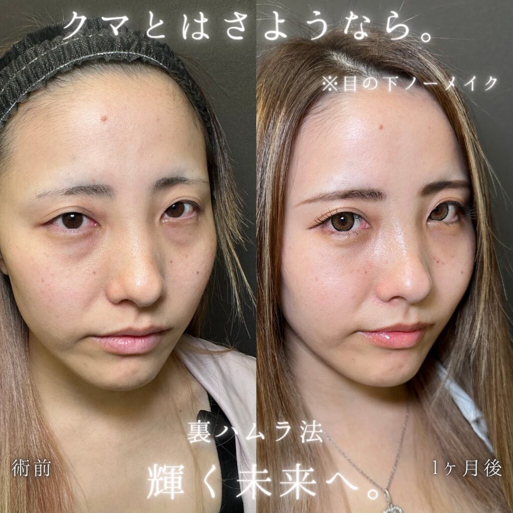 裏ハムラ法の症例写真 (32)