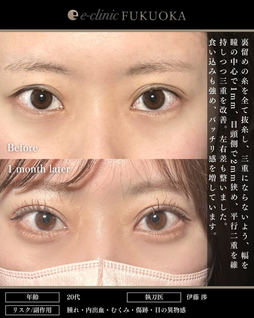 他院埋没裏留め抜糸と自然癒着法の症例写真 (2)