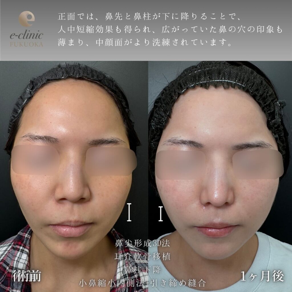 鼻尖形成と軟骨移植と鼻柱下降と小鼻縮小の症例写真 (2)