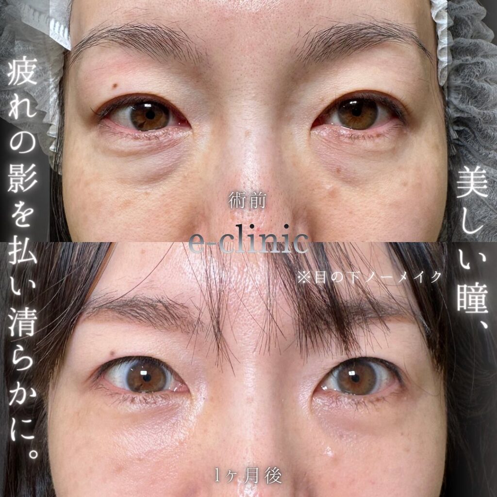 裏ハムラ法と脂肪注入の症例写真 (7)