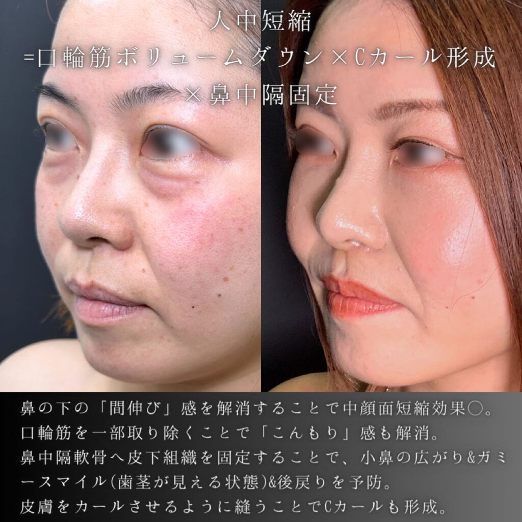 裏ハムラ方と脂肪注入と人中短縮 の症例写真 (3)