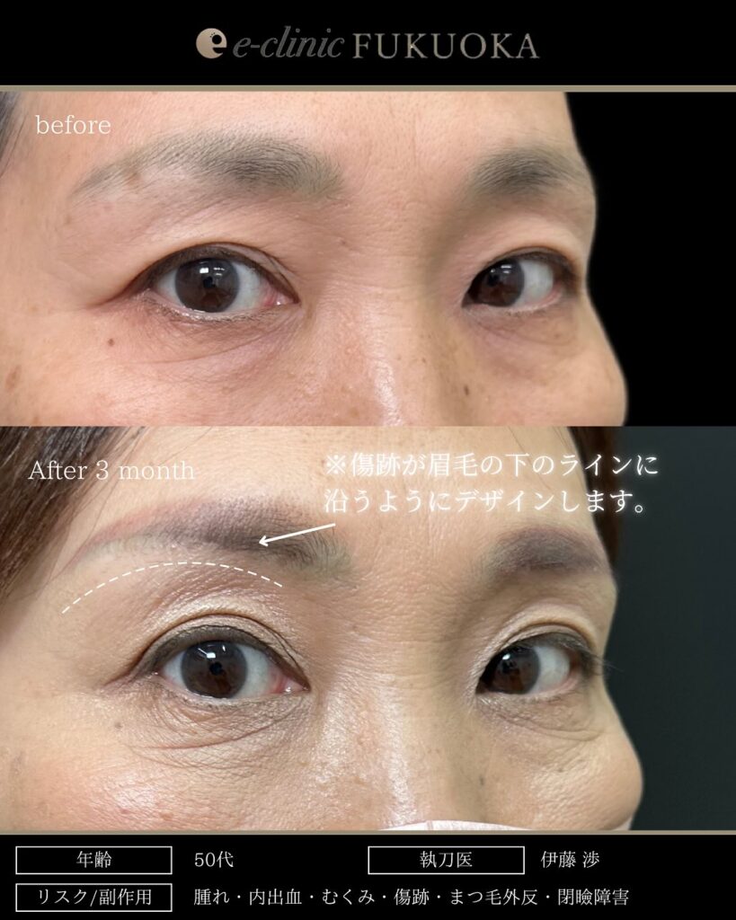 眉下切開の症例写真 (12)