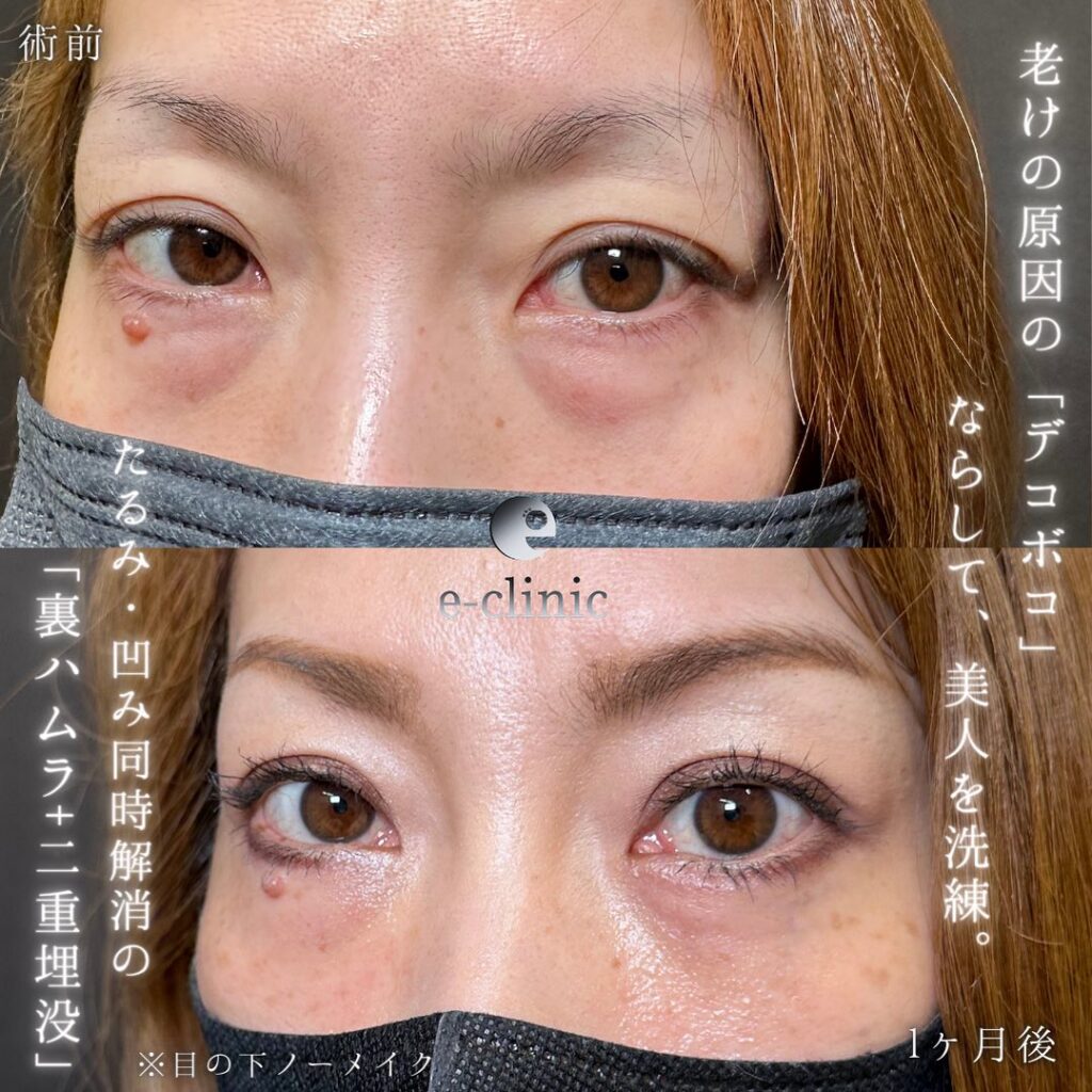 裏ハムラ法と埋没法の症例写真 (2)