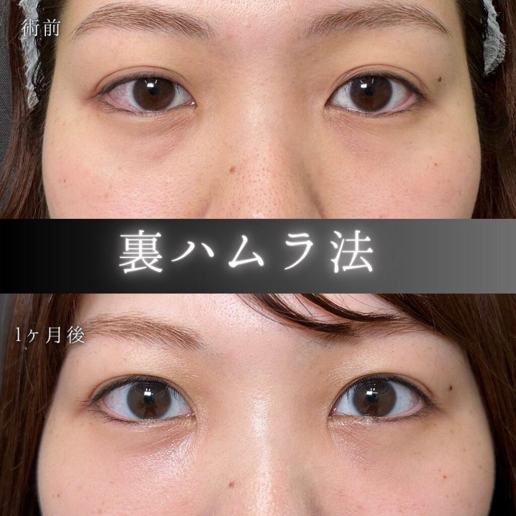 裏ハムラ法の症例写真 (43)