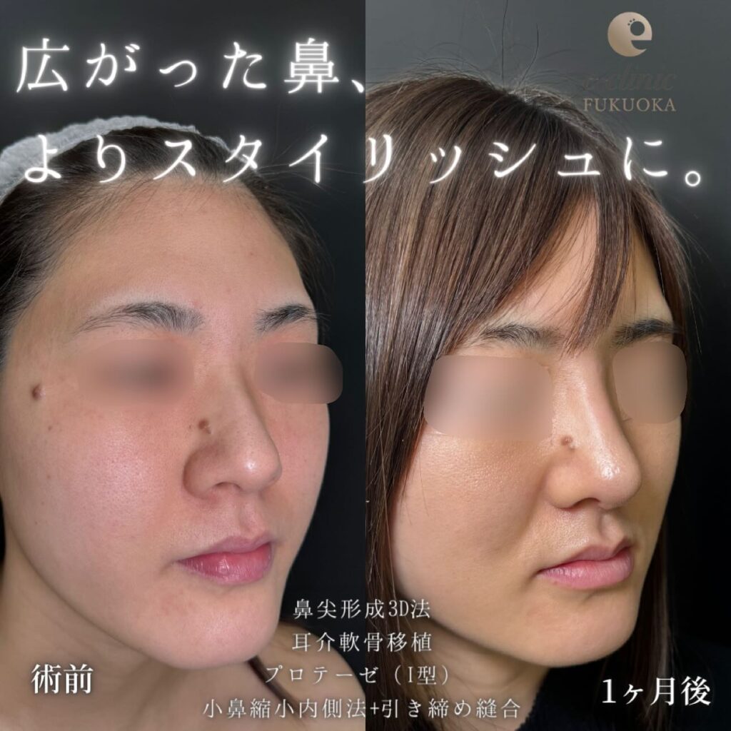 鼻尖形成と軟骨移植とプロテーゼと小鼻縮小の症例写真 (1)