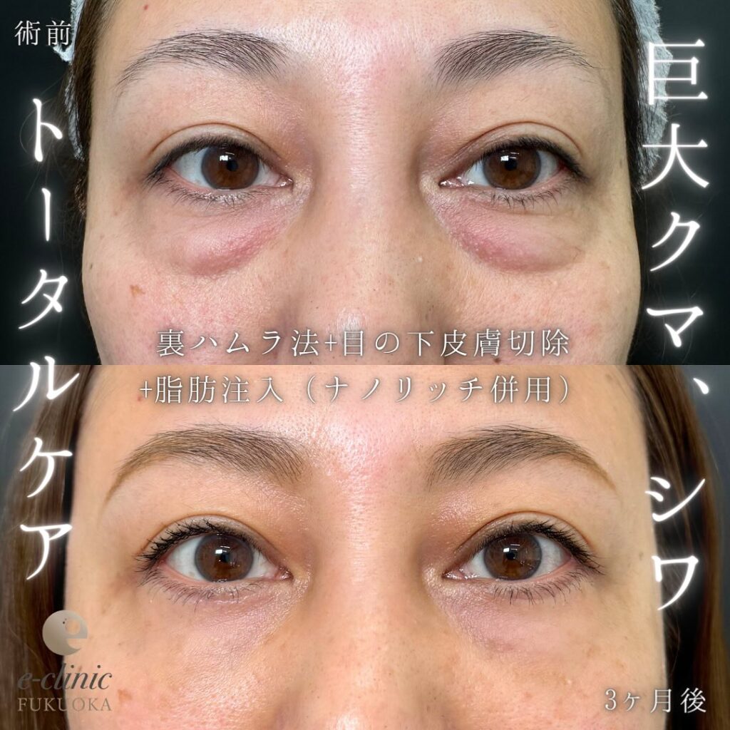 裏ハムラ法と脂肪注入の症例写真 (13)