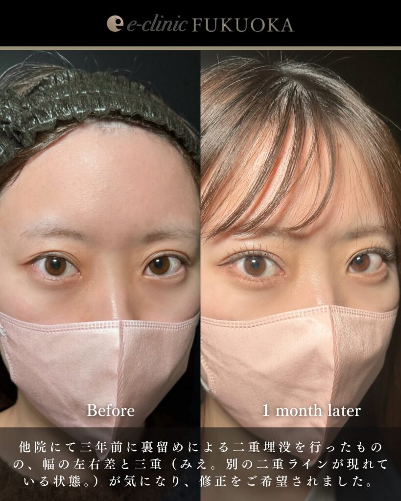 他院埋没裏留め抜糸と自然癒着法の症例写真 (3)