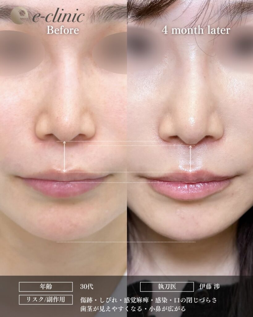 人中短縮の症例写真 (34)