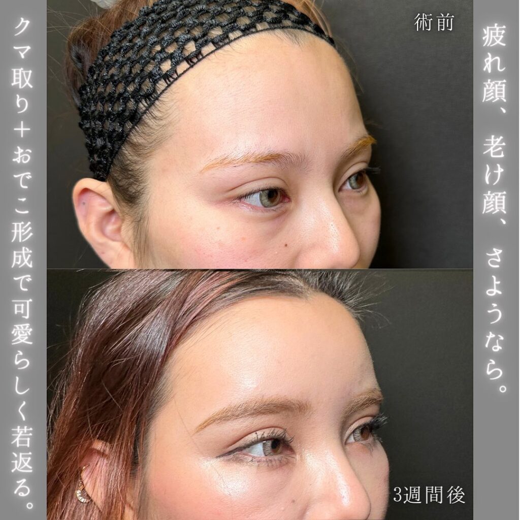 脱脂と脂肪注入と額とこめかみの脂肪注入の症例写真 (2)