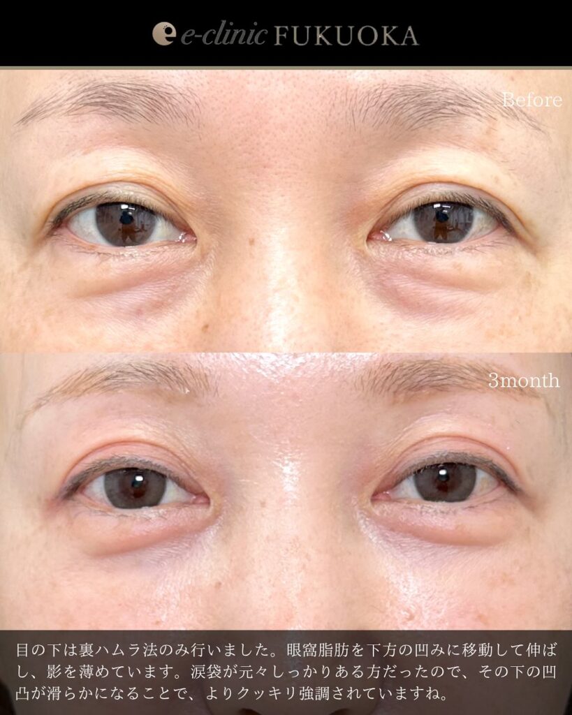 眉下切開と裏ハムラ法の症例写真 (4)